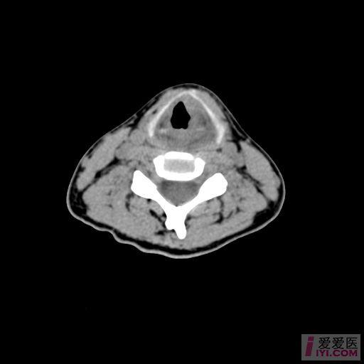 原创喉部ct
