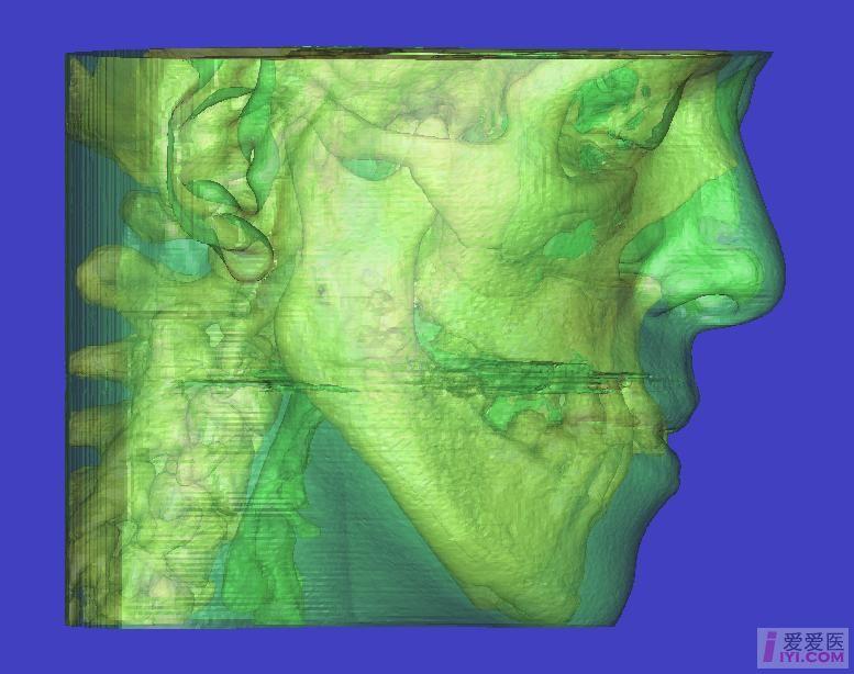【原創】ct圖三維重建 - 口腔醫學專業討論版 - 愛愛醫醫學論壇