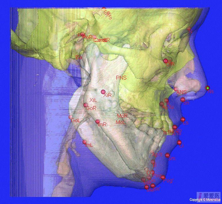 【原创】ct图三维重建 - 口腔医学专业讨论版 - 爱爱医医学论坛