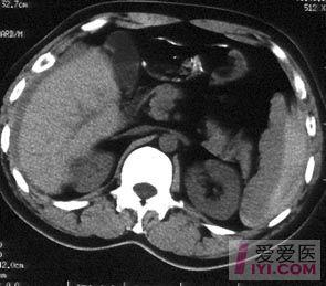 原创经典ct图片脾破裂