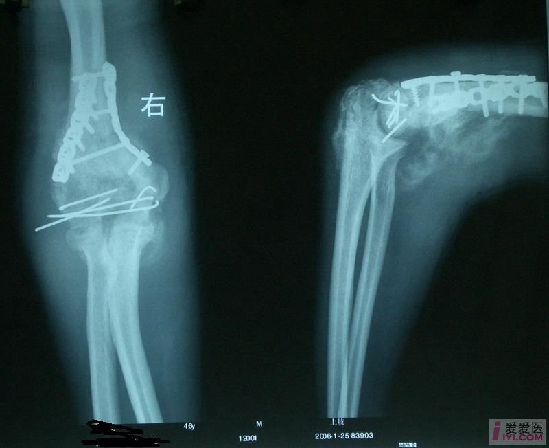 原创肘关节骨折术后骨化性肌炎多图