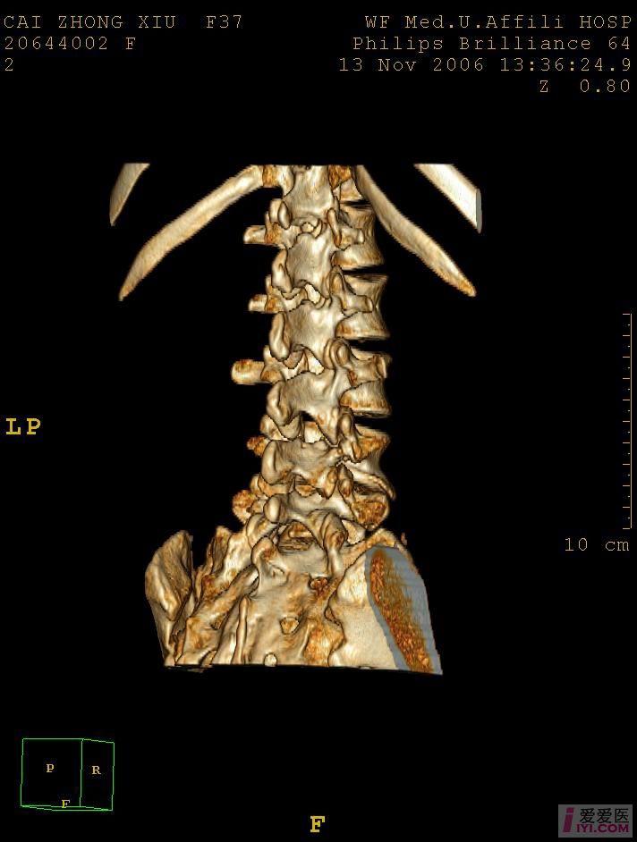 颈椎椎弓峡部裂图片图片