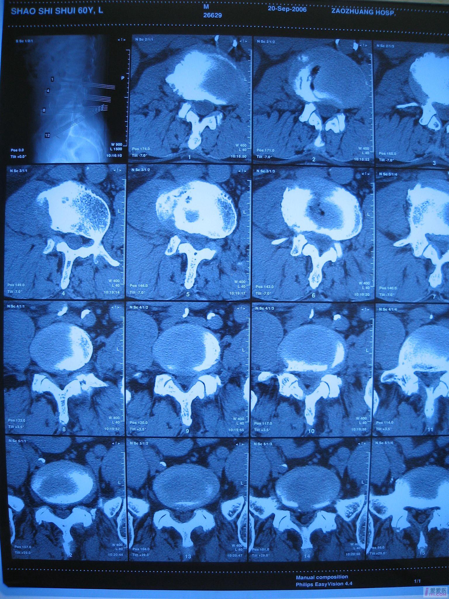 椎管狭窄影像学图片图片