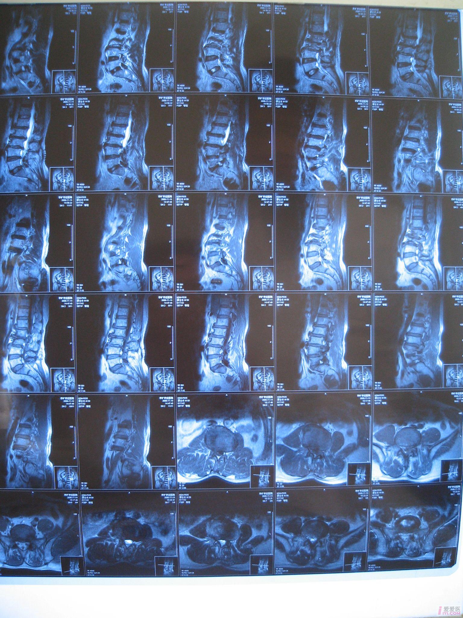 讨论腰突症术后复发并椎管狭窄腰椎退行性变的治疗