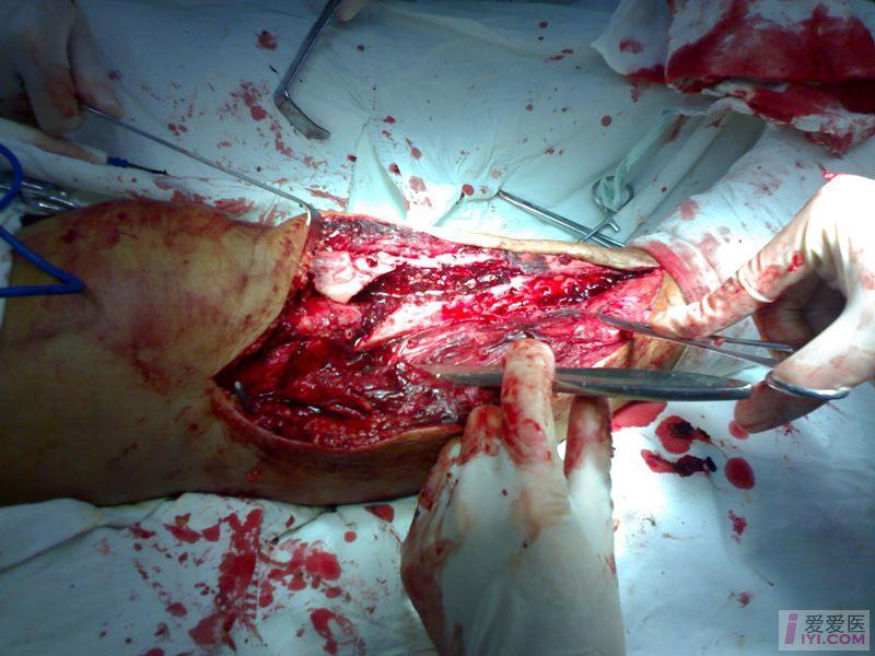 讨论右胫腓骨陈旧新鲜骨折