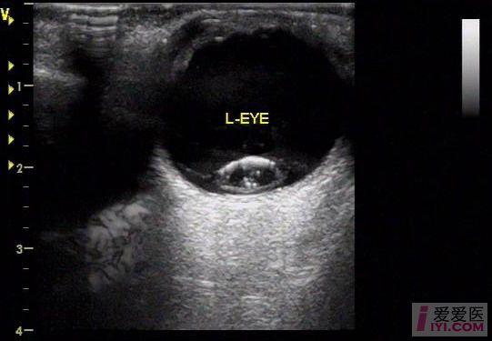 【原创】晶状体脱位