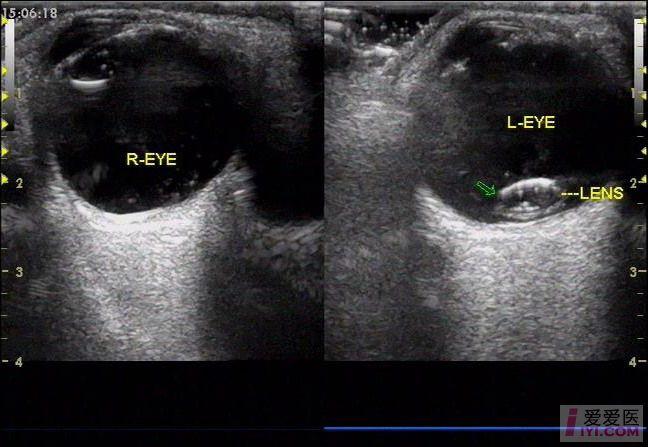 原创晶状体脱位
