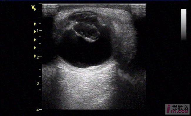 【原创】晶状体脱位 - 超声医学讨论版 - 爱爱医医学论坛