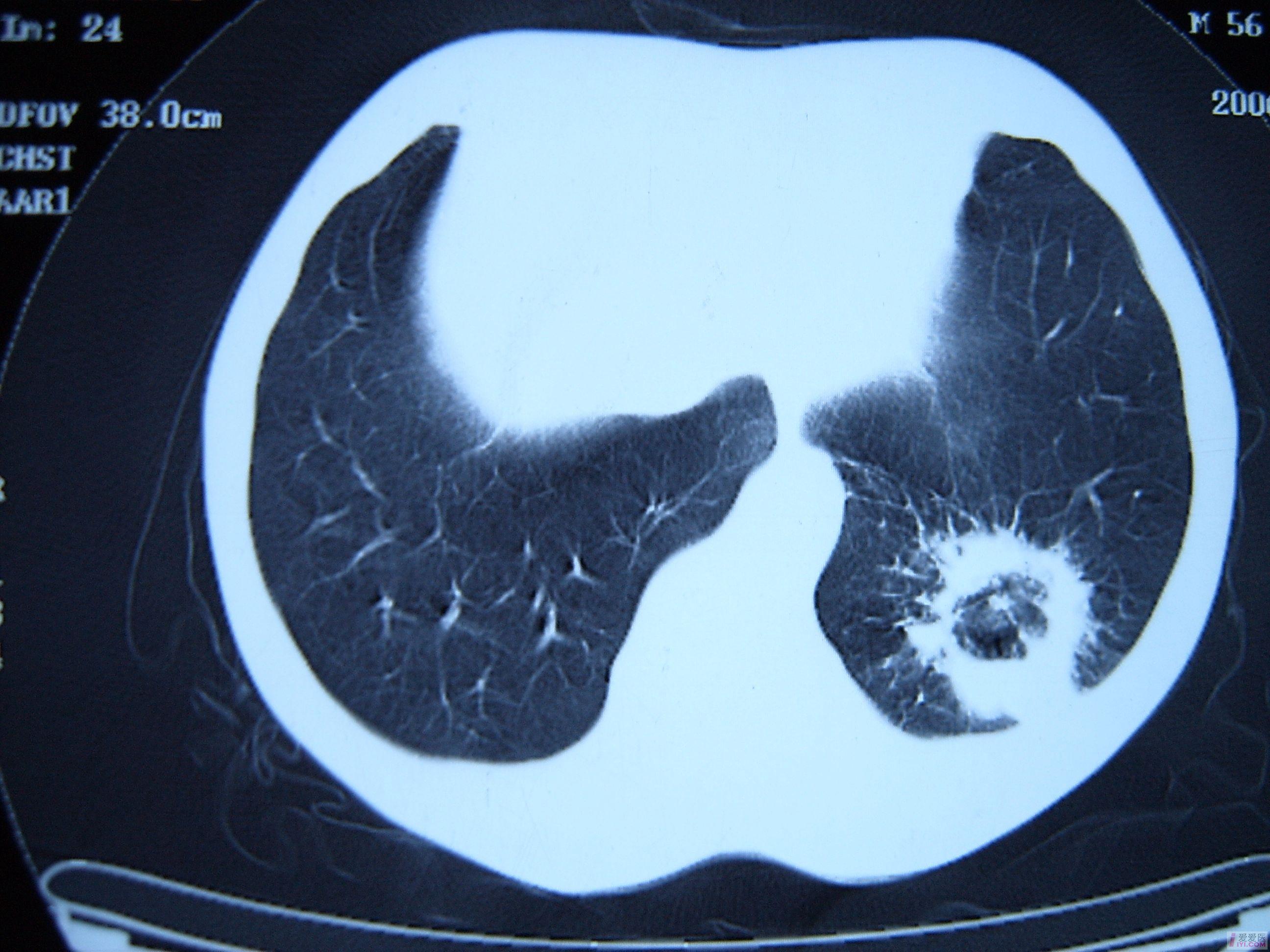 肺空洞ct图片图片