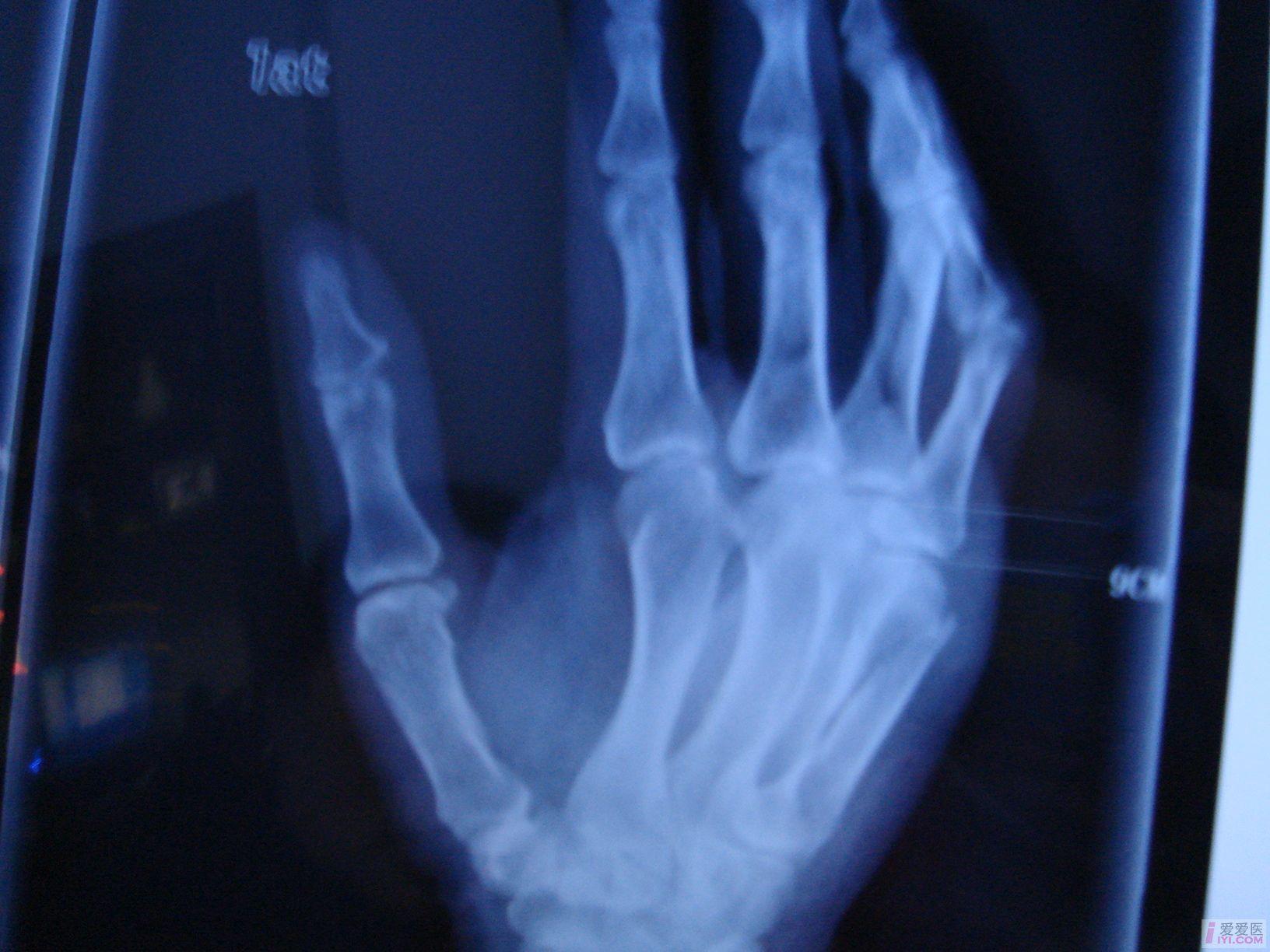 讨论】第５掌骨骨折治疗方法- 骨科与显微外科专业讨论版- 爱爱医医学论坛-
