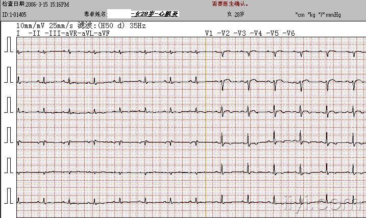 心包炎的心电图图片
