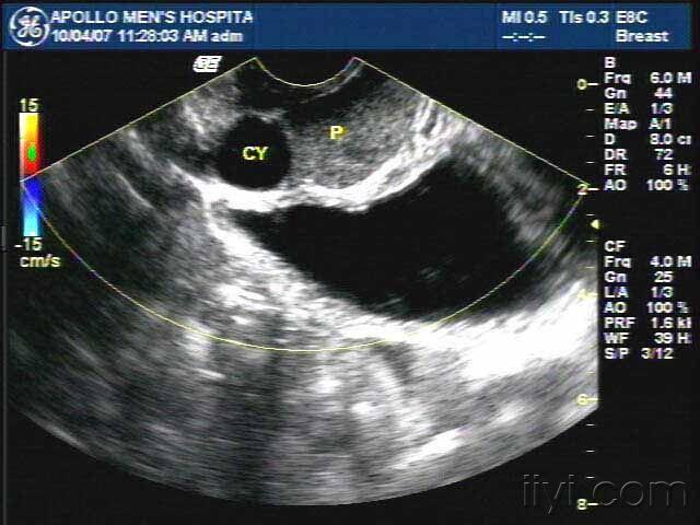 前列腺囊肿彩超图片图片