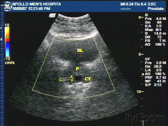 前列腺囊肿彩超图片图片