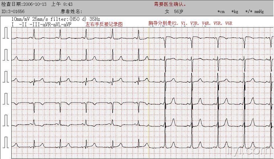 3-01656--女56岁-右位心b型预激(纠正导联)