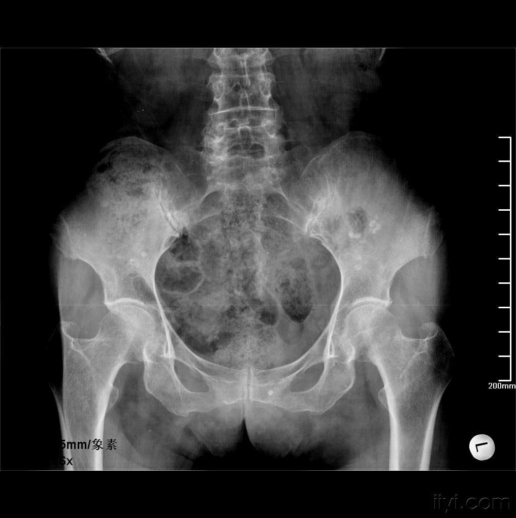 正常的女性骨盆ct图片图片