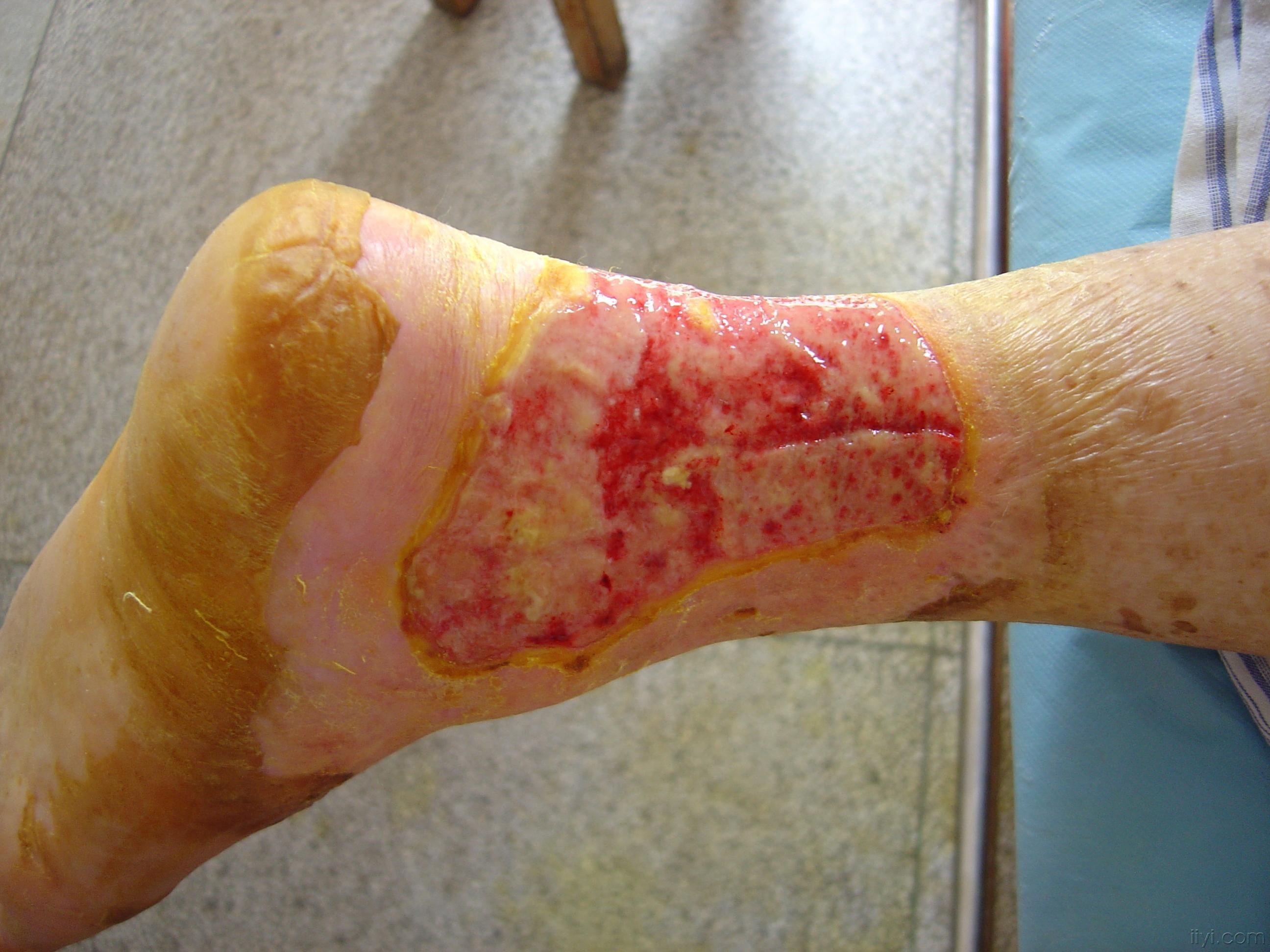 烧伤植皮手术后皮肤图图片
