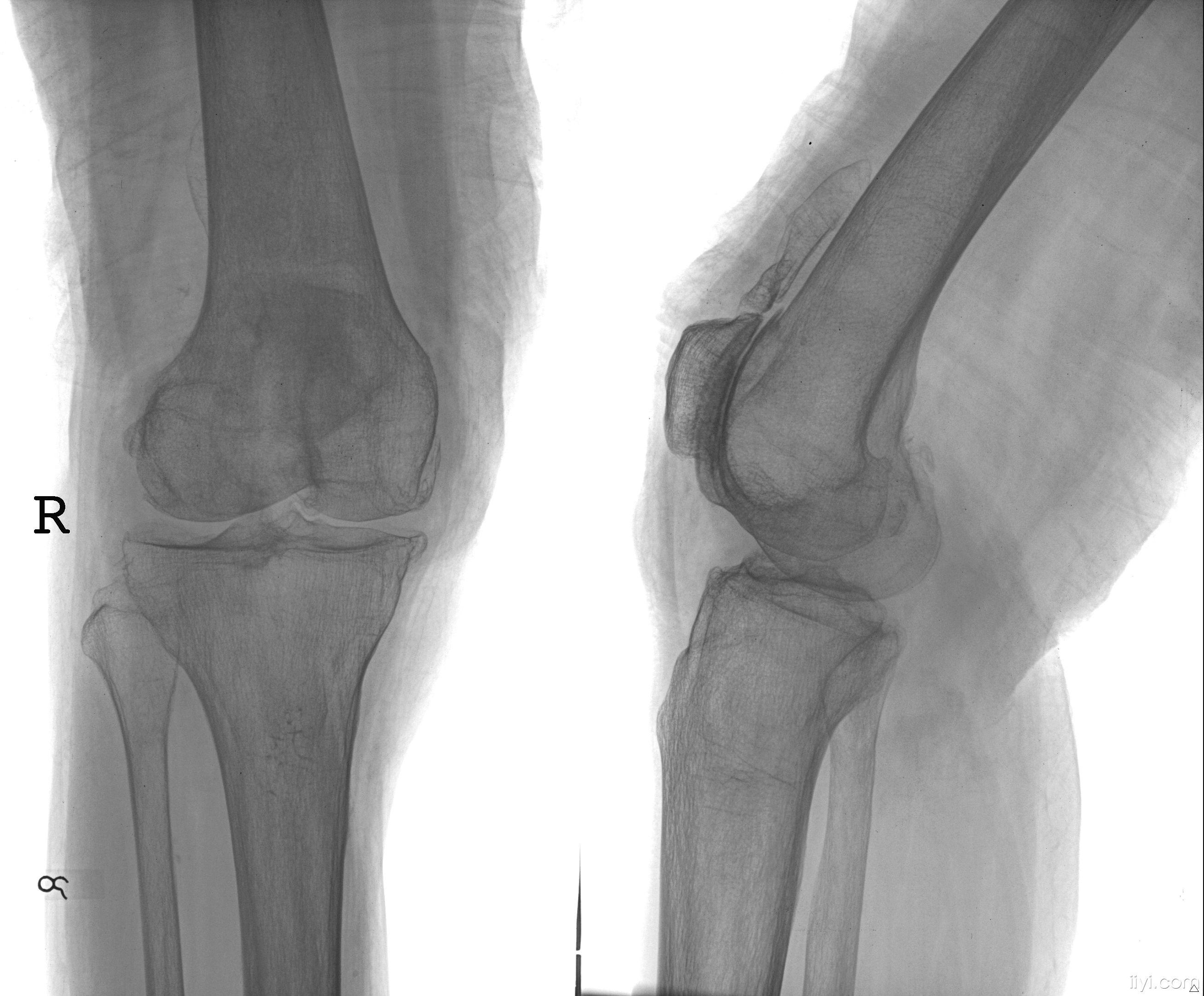 女性膝盖酸痛是缺钙吗 缓解膝盖疼痛的妙法