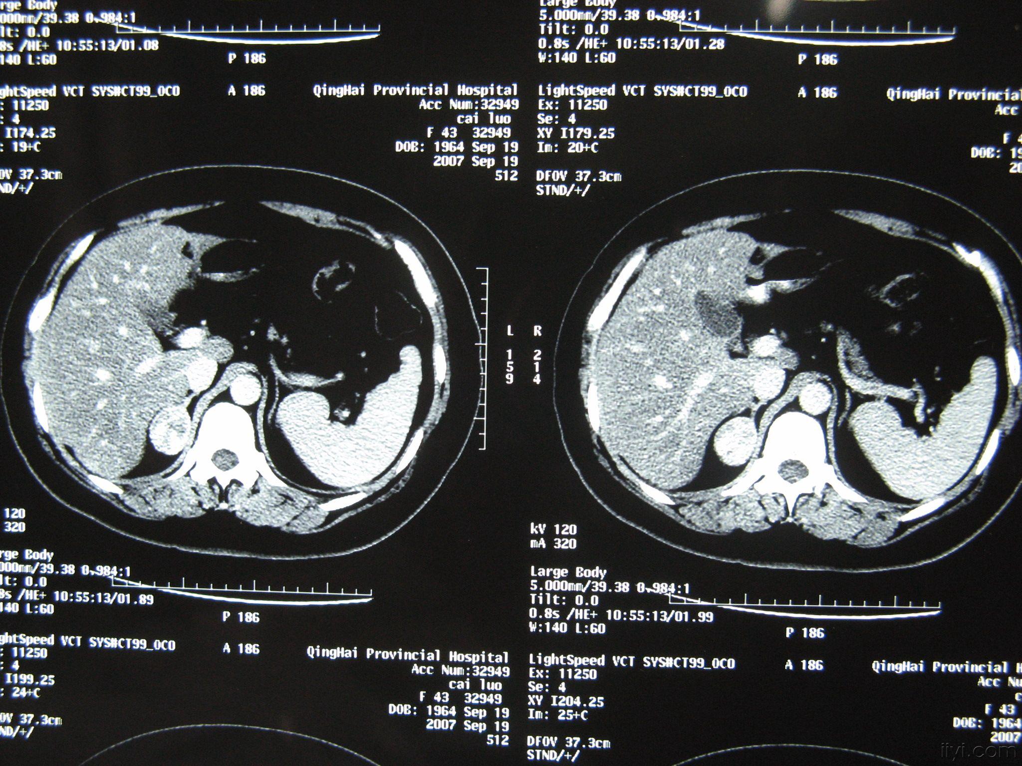 肾上腺腺瘤CT图片