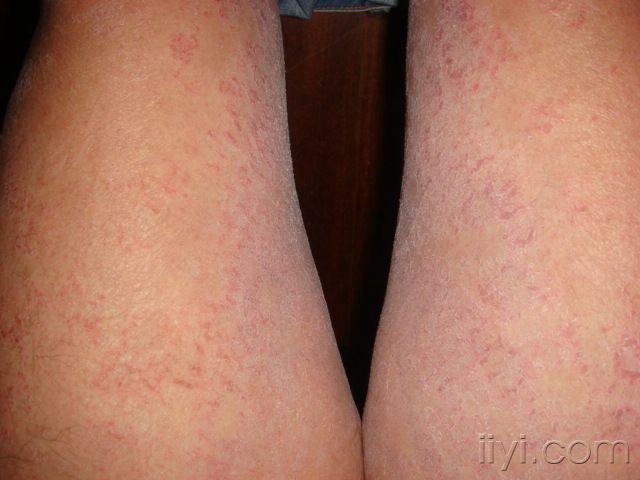 求助有图请问是过敏玫瑰糠疹还是其他皮肤病