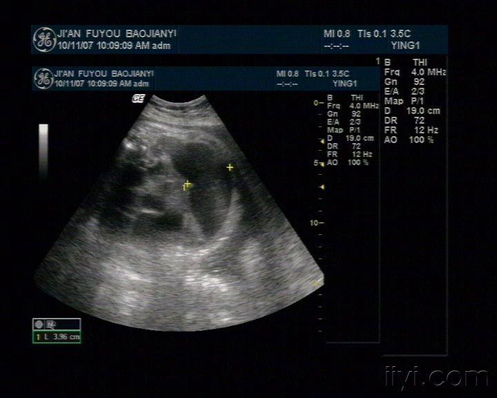 肠梗阻(肠闭锁可能)