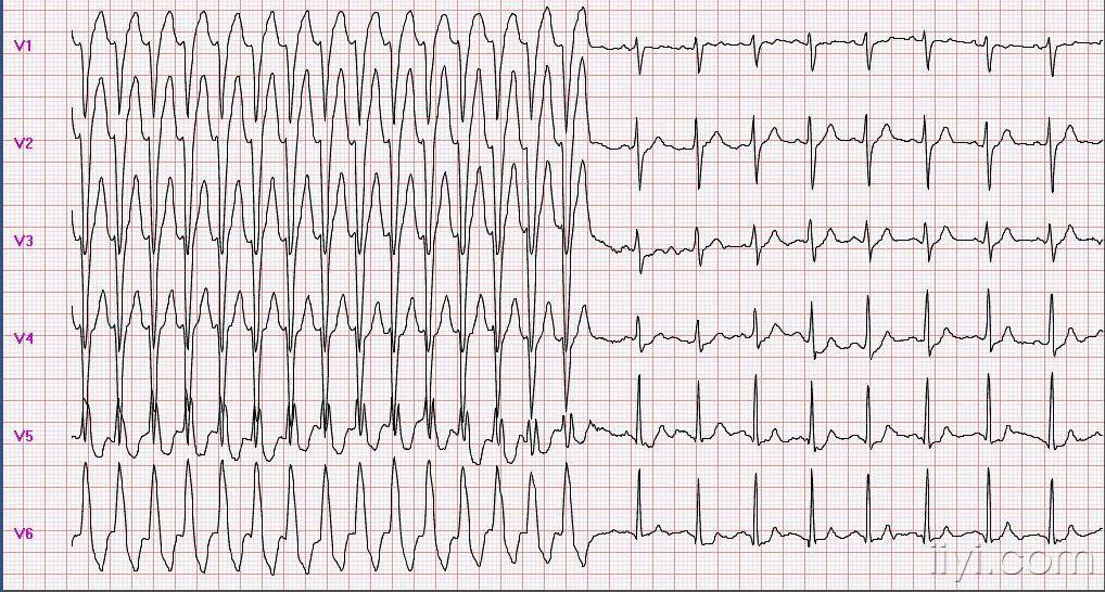 宽qrs心动过速的鉴别