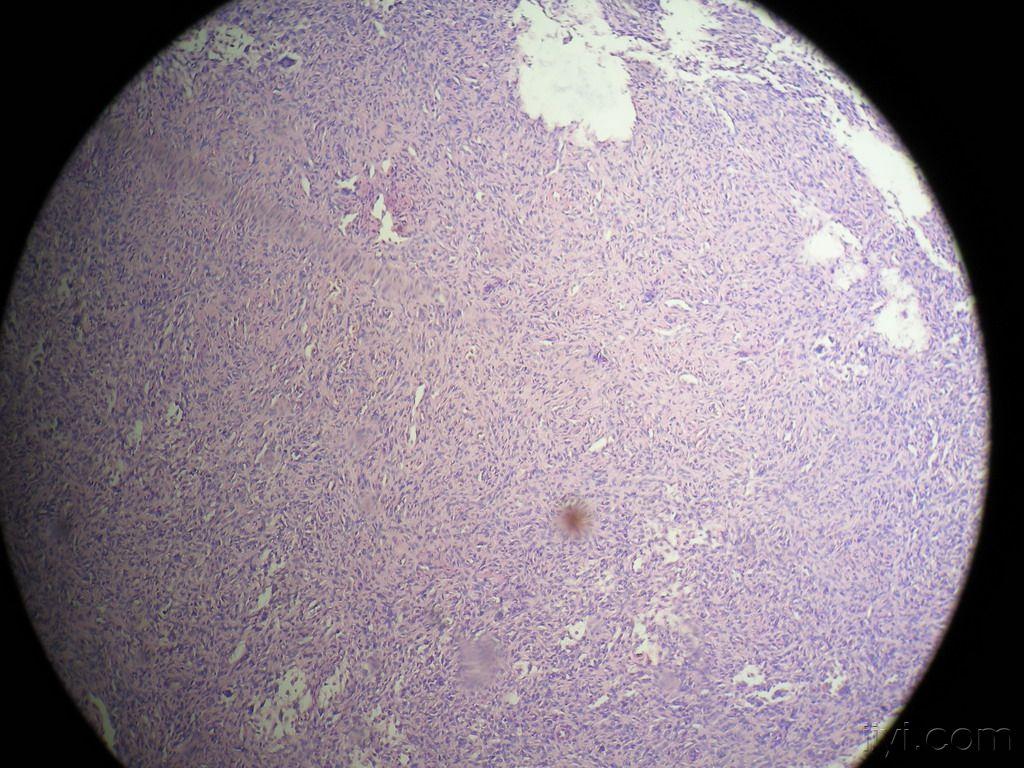 门诊病例9隆突性皮肤纤维肉瘤