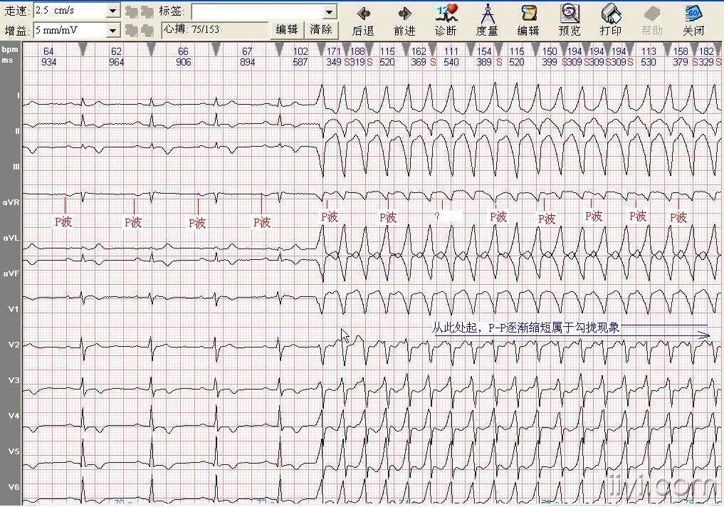 请分析一份心电图  难得的好图一份,记录了宽qrs心速的起止处
