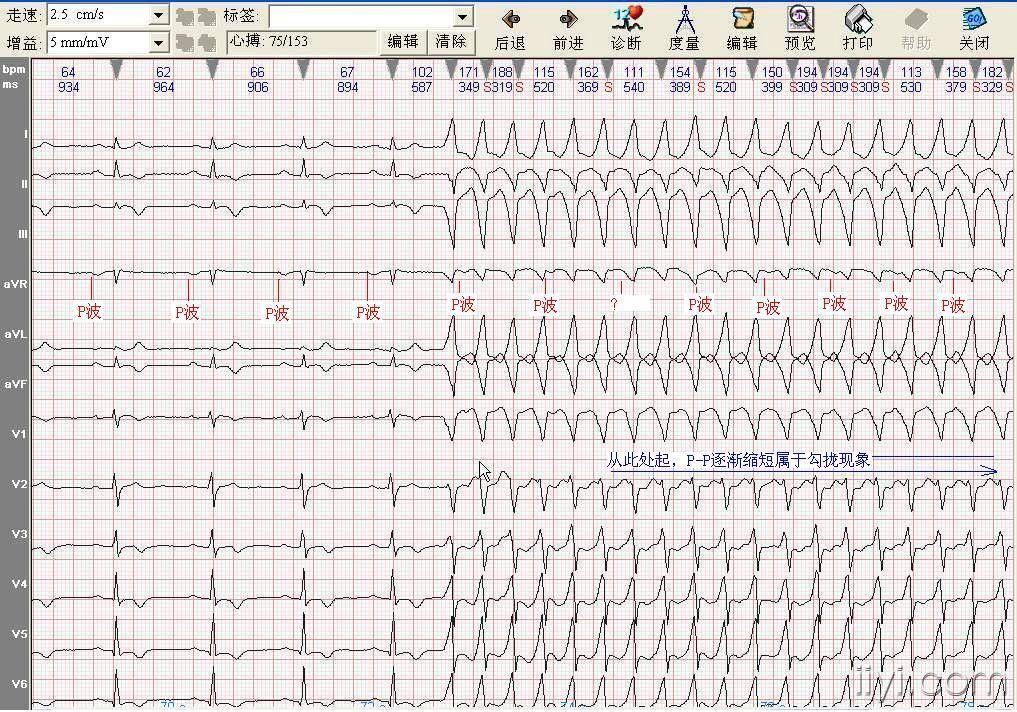 短阵性宽qrs心速-室速-1.jpg