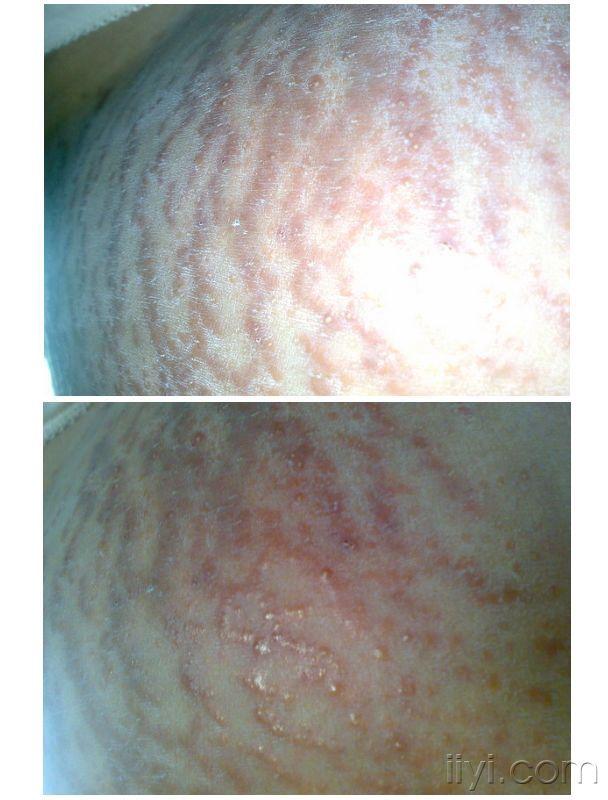 这是孕晚期妊娠纹荨麻疹吗还是什么疹