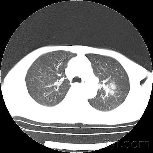 什么情况需要做增强肺ct 20071103_e765e5c058c03b6018fbhXXwGxNPU5oD.jpg