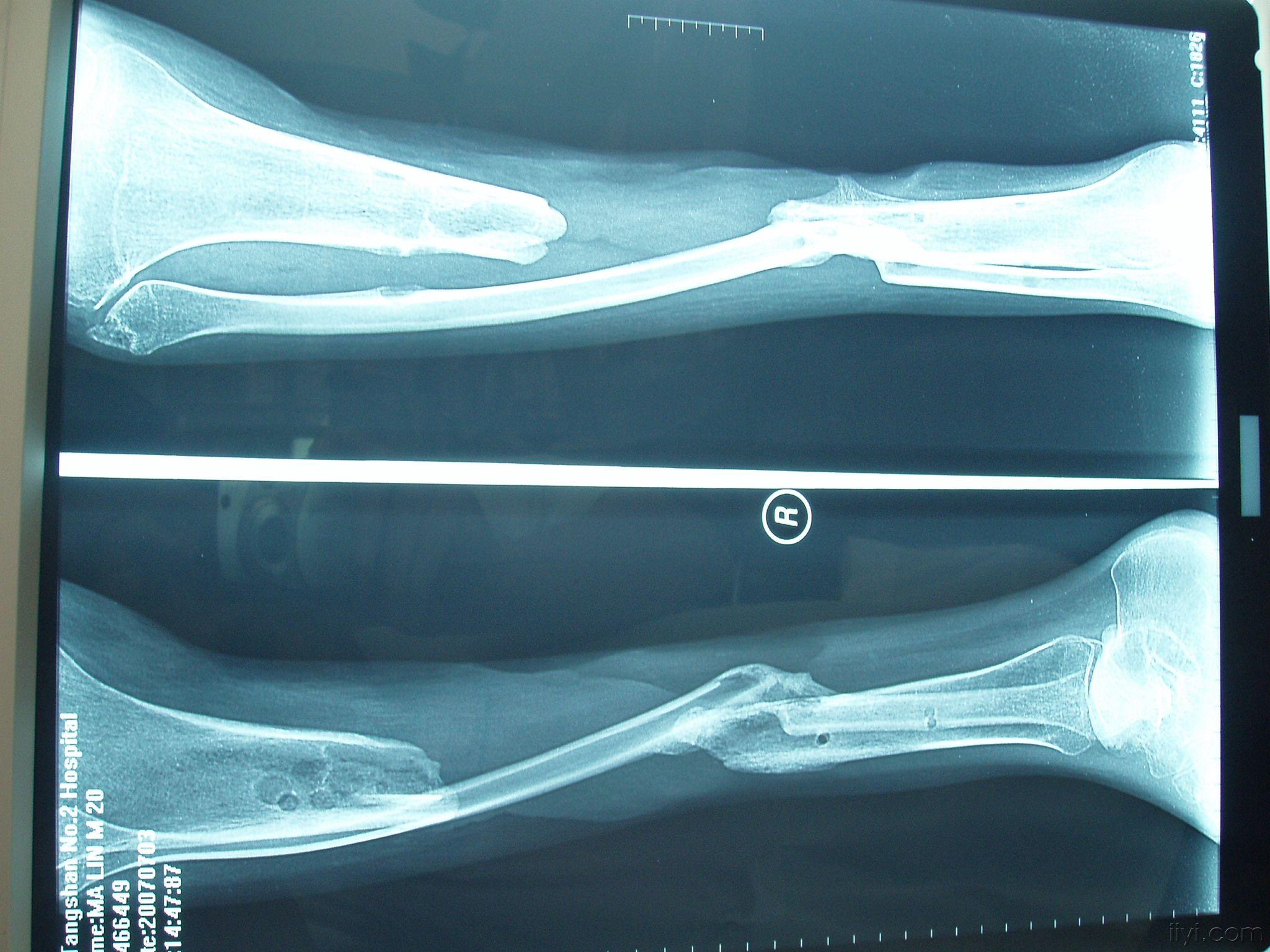 胫骨缺损------征求治疗方案 - 骨科与显微外科专业讨论版 - 爱爱医