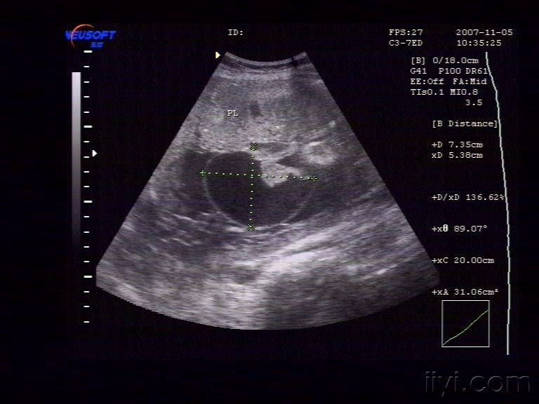 羊膜腔内囊性占位 - 超声医学讨论版 - 爱爱医医学论坛