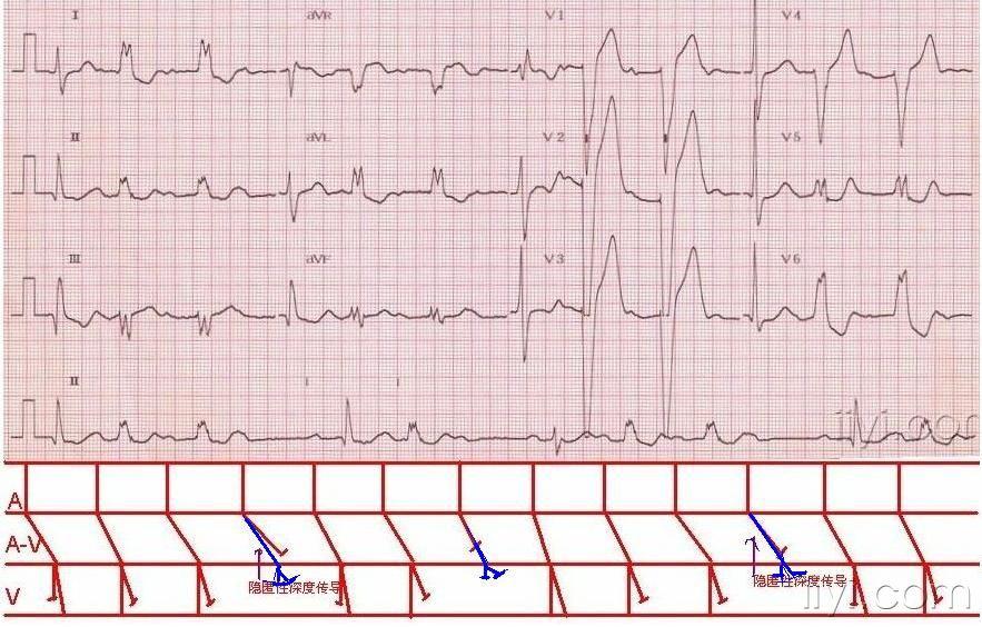 图例- 心电图脑电图专业讨论版 - 爱爱医医学论坛