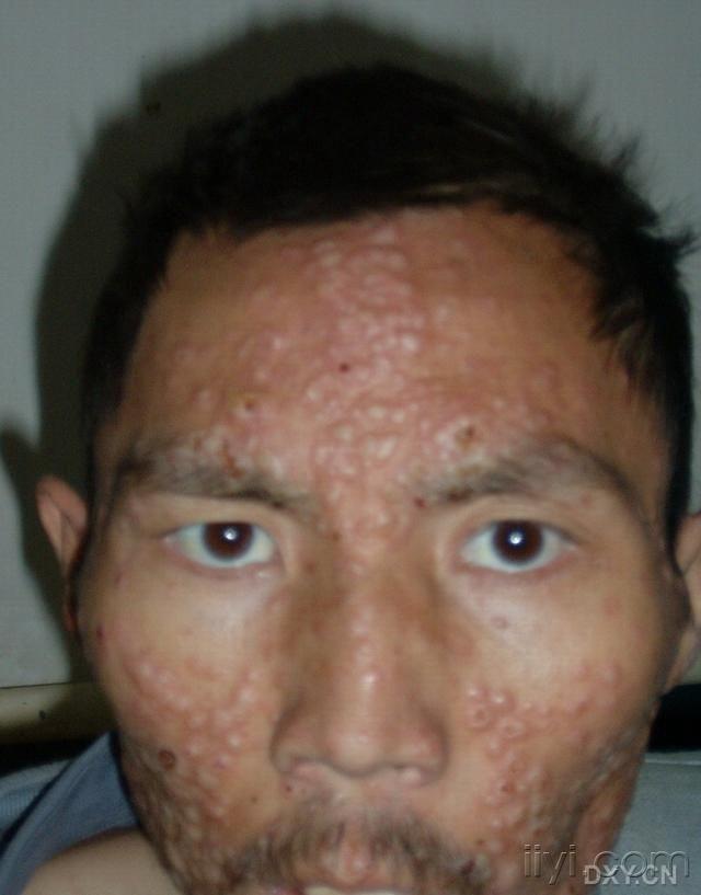 艾滋病皮肤症状脸部图片