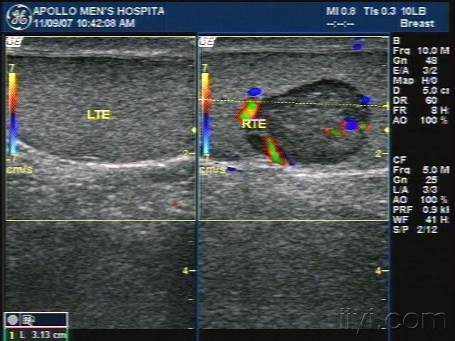 睾丸肿瘤!大家帮忙看一下!