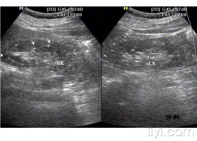 双肾多发钙化灶一例
