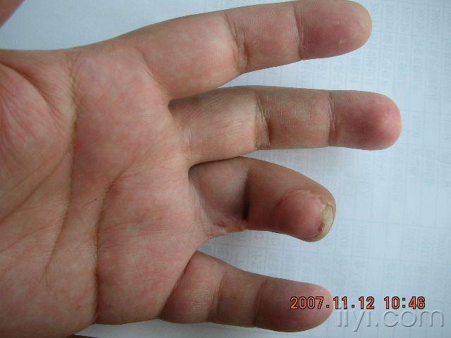 指动脉皮瓣术后疤痕挛缩