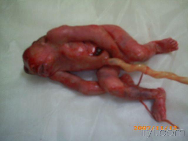 三个月引产胎儿图真实图片