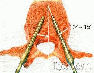 颈椎椎弓根钉进针点图图片