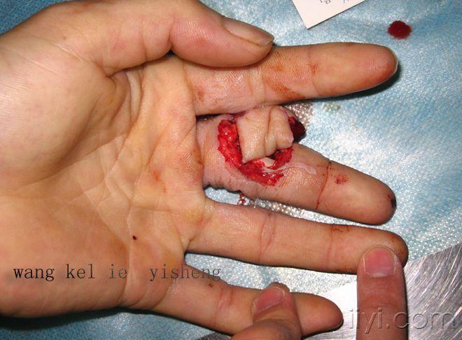 术前照片 圆形空心磨具冲压伤 仅剩少许深筋膜相连 无血循环