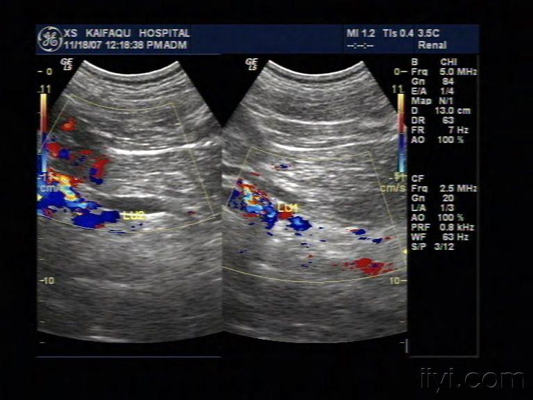 重复肾超声表现图片图片