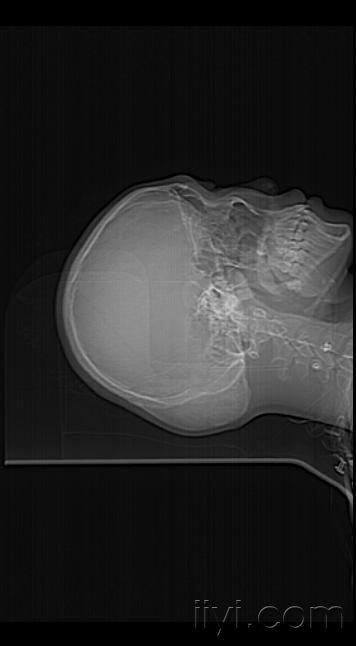 额骨骨瘤ct图片