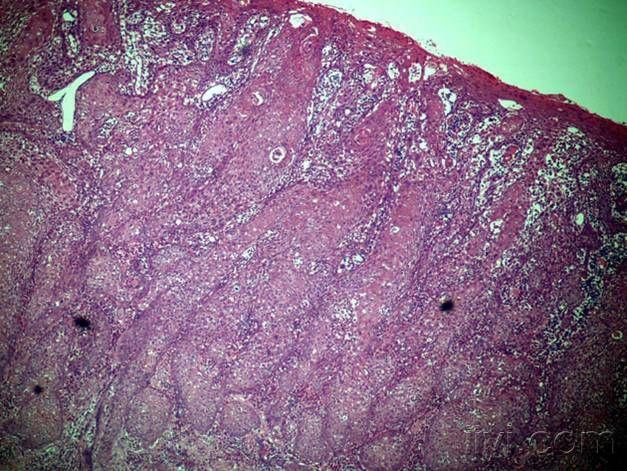 腹股沟  冠状沟  淋巴结肿大  皮肤  外用药