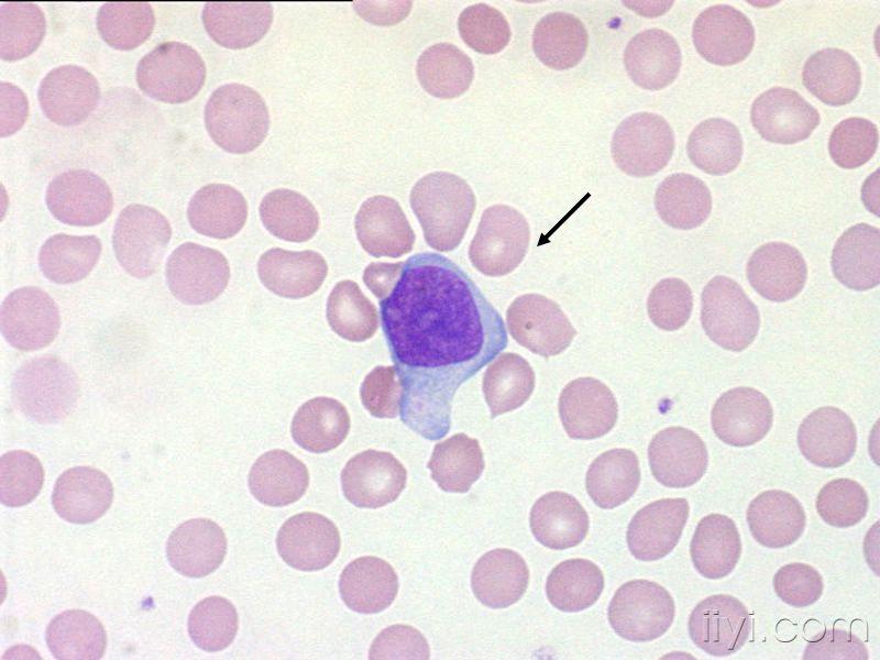 日本血液学会的异型淋巴细胞图片