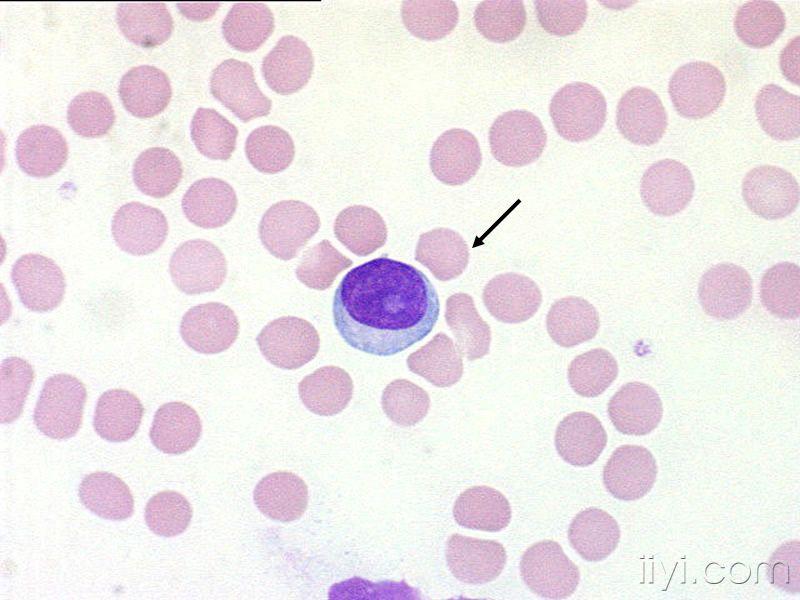 异性淋巴细胞图片