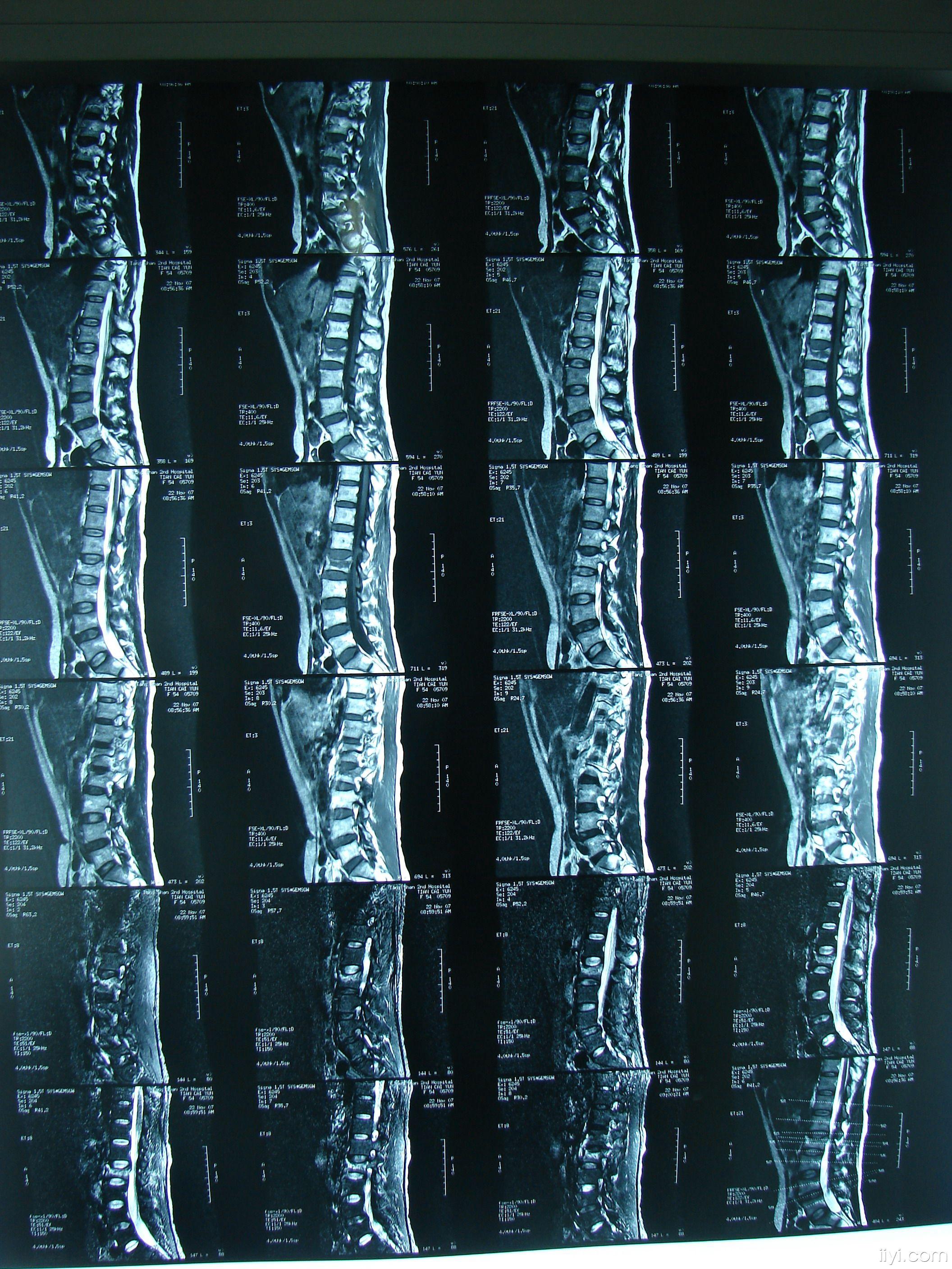 腰椎骨折x光图片