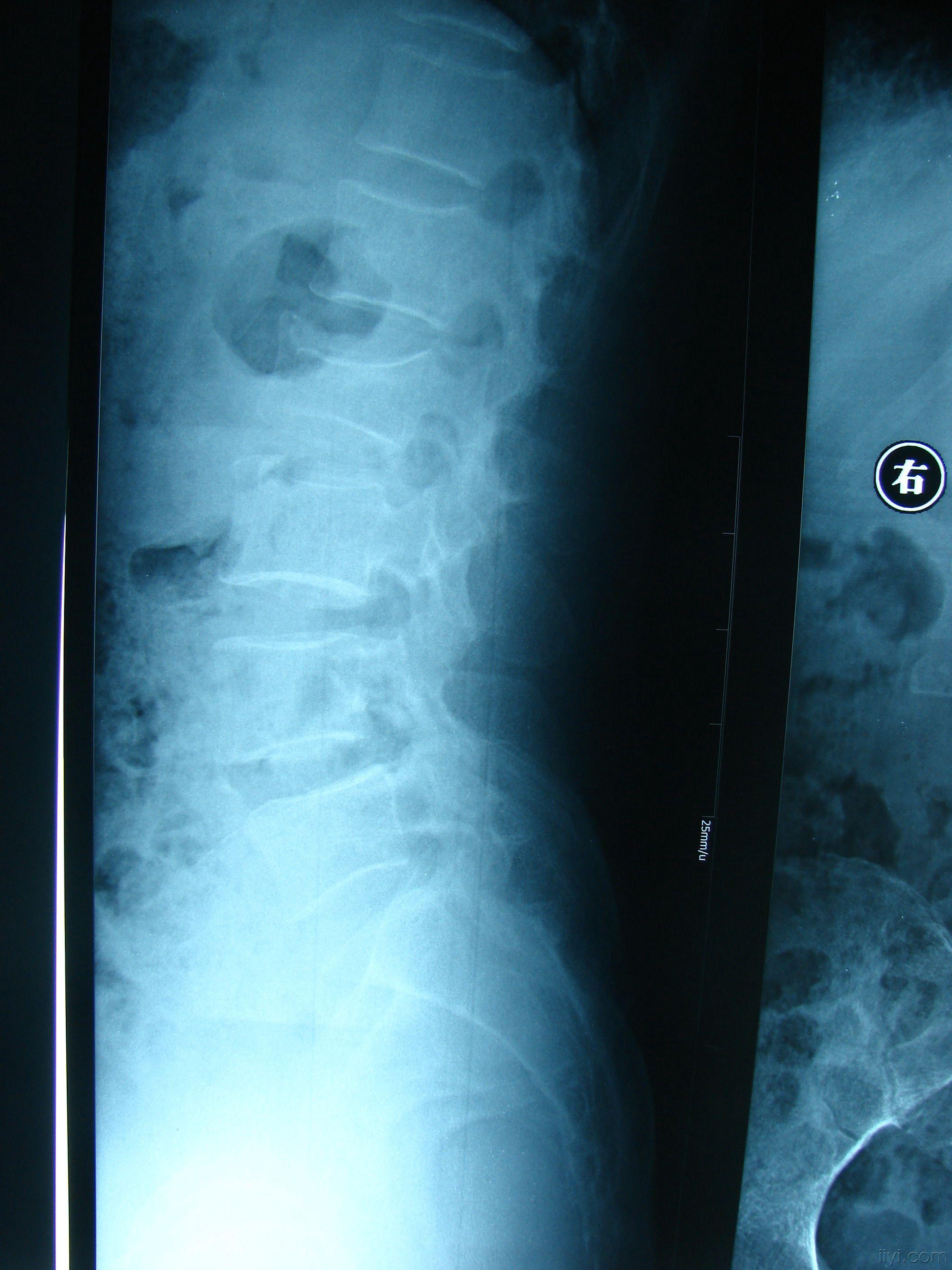 腰椎骨折x光片图片