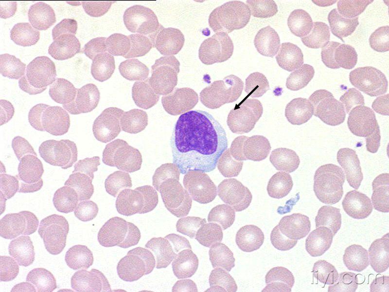 日本血液学会的异型淋巴细胞图片