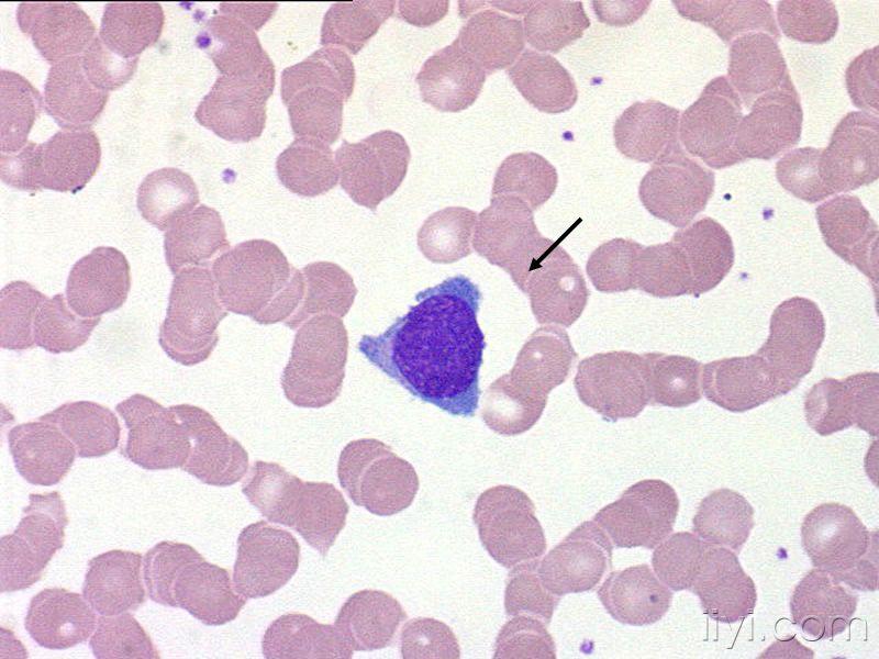 日本血液学会的异型淋巴细胞图片