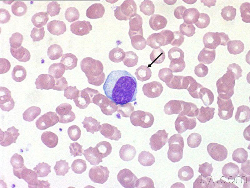 异型淋巴细胞图片